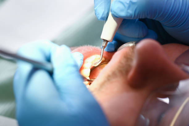 Best Emergency Treatment for Dental Infections or Abscesses in Murray, UT